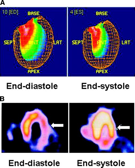 lv gated images|Gated Myocardial Perfusion SPECT: Basic Principles, .